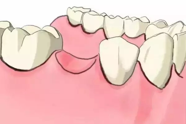 烤瓷牙修複