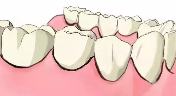 烤瓷牙修複牙齒單顆缺失