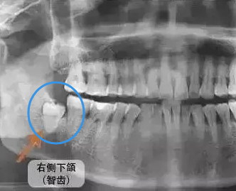 拔智齒前要準備什麽(me) 