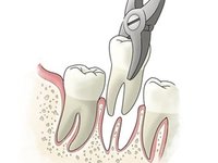 微創拔牙收費標準