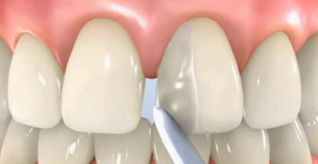 樹脂補個(ge) 小牙縫多少錢