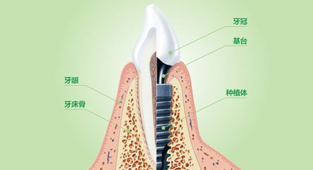 深圳種植牙一隻多少錢