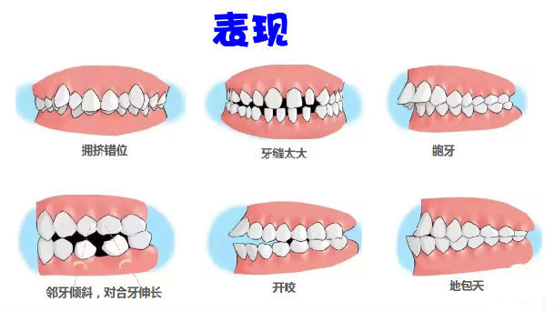 上牙和下牙錯位可以矯正嗎