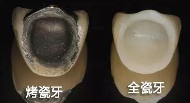 全瓷牙和烤瓷牙哪個(ge) 更耐用