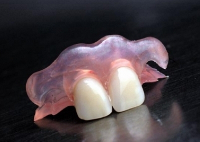 拔完牙多久才能做隱形義(yi) 齒