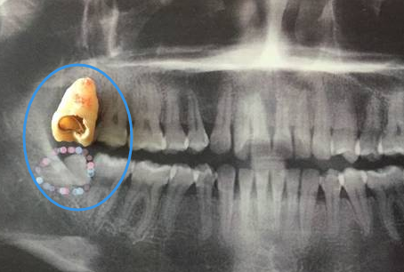 智齒隻露出來一點點能不能拔