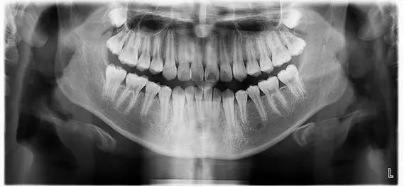牙齒矯正前拍片要多少錢