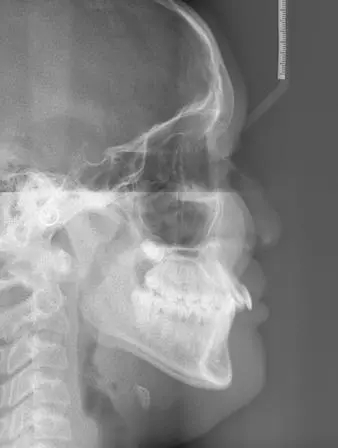 牙齒矯正前拍片