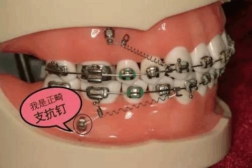 支抗釘（骨釘）的問題