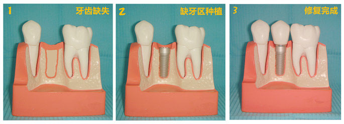 種牙有什麽(me) 條件限製，較低價(jia) 格是多少