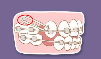 正畸打骨釘可怕嗎,適合哪些牙齒畸形