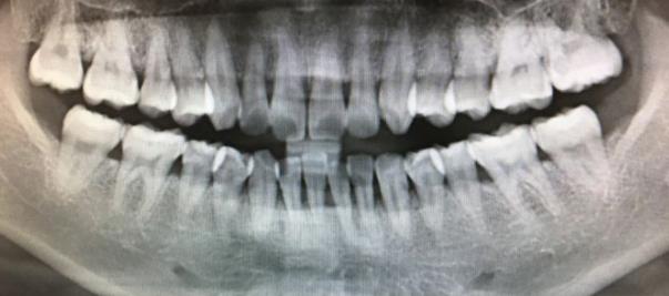 牙根短能不能矯正