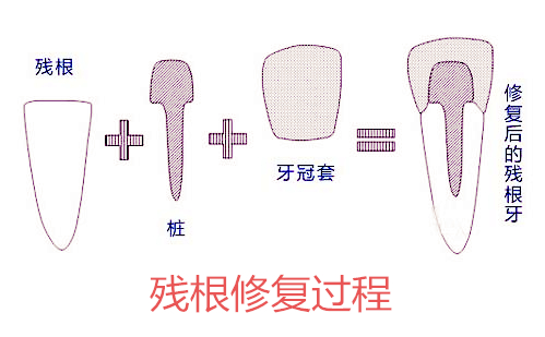 牙齒隻剩下牙根，還能保住嗎