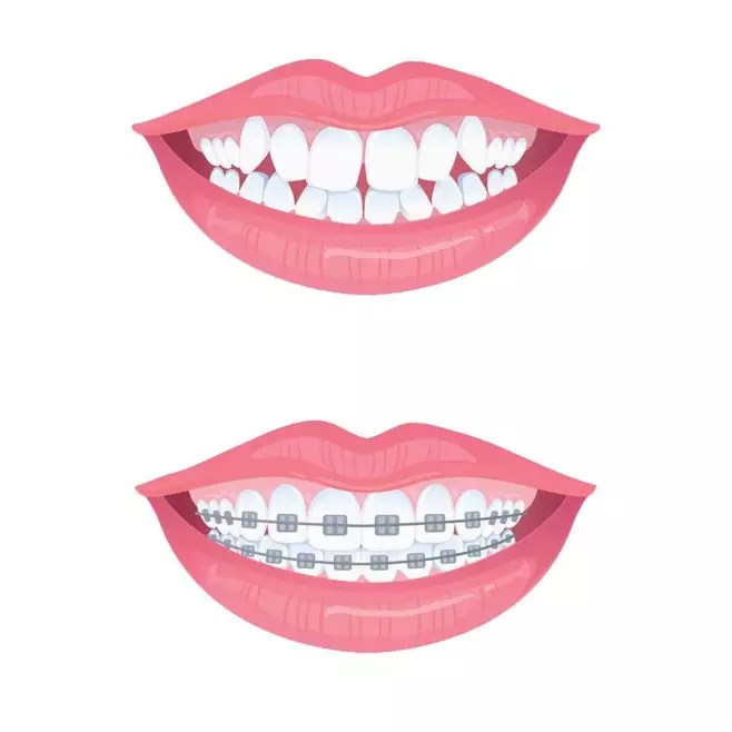 長期塞牙，可能是有這些牙齒問題