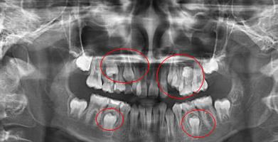 口腔全景拍片多少錢
