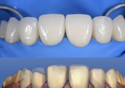 烤瓷牙上火疼痛怎麽(me) 辦