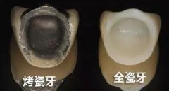 進口全瓷牙價格