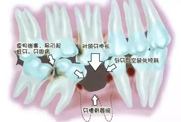 種植牙之前還需要矯正，這是為(wei) 什麽(me) 