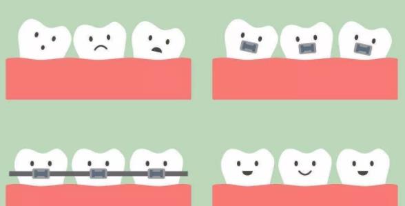 戴牙套治療長歪的牙齒