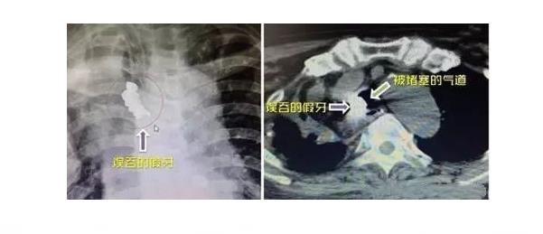 睡前不摘活動假牙