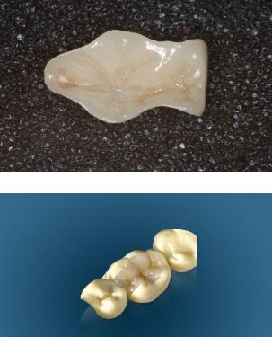 瓷嵌體(ti) 費用大約要幾千