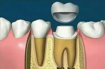 牙齒碎了要鑲牙，一般多少錢