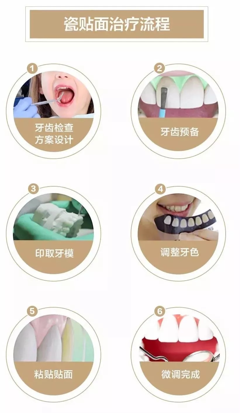 輕度四環素瓷貼麵美白價(jia) 格