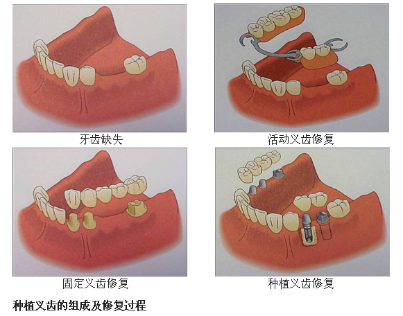 拔了大牙,其他牙齒會(hui) 鬆嗎