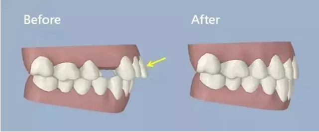 拔牙痛還是分牙痛