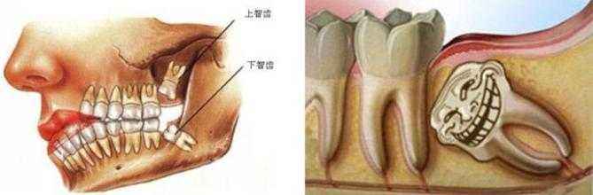 上麵的智齒好拔嗎?需要多久
