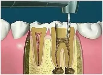 門牙做根管治療