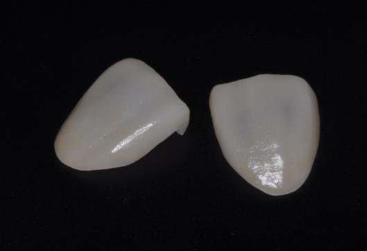 牙齒貼片和戴牙套一樣嗎