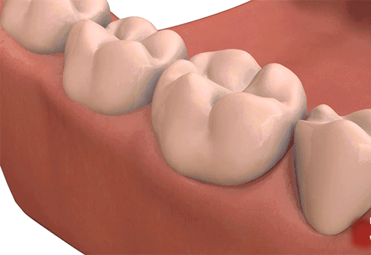 洗牙之後牙齒酸痛正常嗎