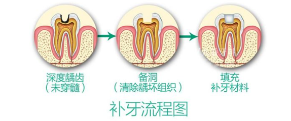 輕微蛀牙不補會(hui) 怎麽(me) 樣
