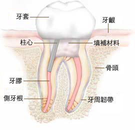 根管治療+牙冠=更好的保護牙齒