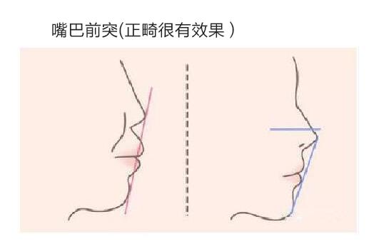 嘴凸正畸整形的大概費用是多少