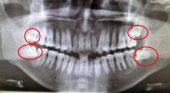 拔掉智齒會(hui) 顯得臉小嗎