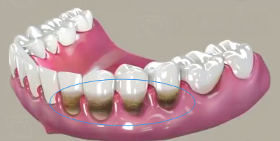 牙齦萎縮是什麽(me) ，可以治療嗎