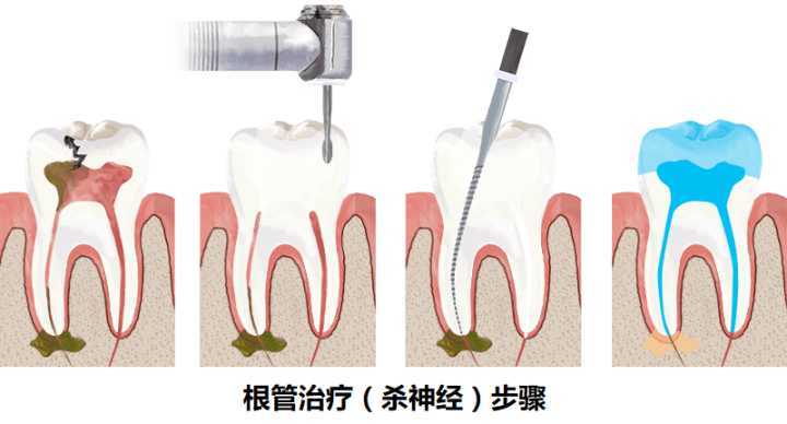 二次根管治療難度大嗎，要多少錢