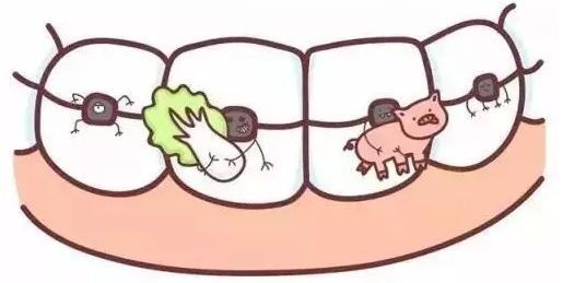 牙齒矯正期間護理須知