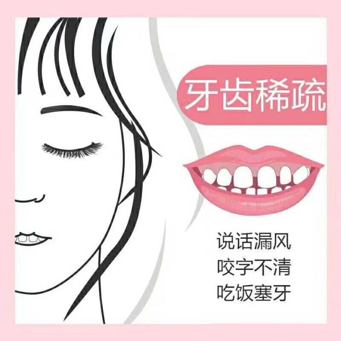 牙齒有牙縫可以帶牙套嗎