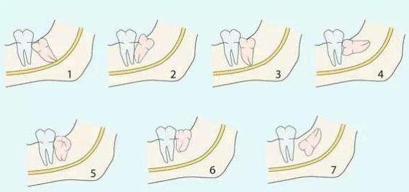 矯正牙齒用不用拔智齒