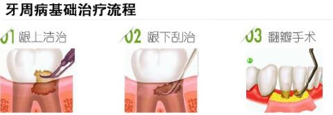 牙周炎要怎麽(me) 治療，多少錢