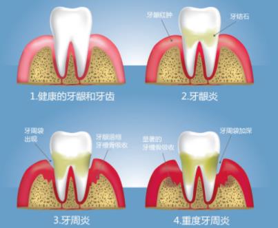 牙齦紅腫出血是牙周病嗎？