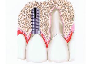 哪些人適合做種即刻植牙