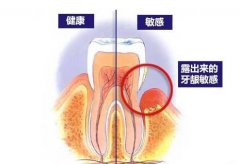深圳超聲波洗牙多少錢一次