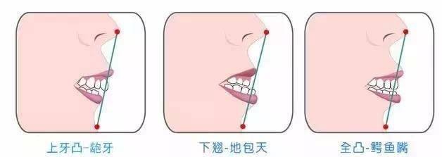 “地包天”的治療時間