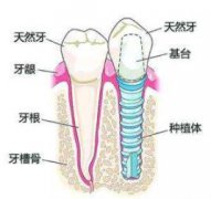 如果把全口牙齒全部換掉要多少錢