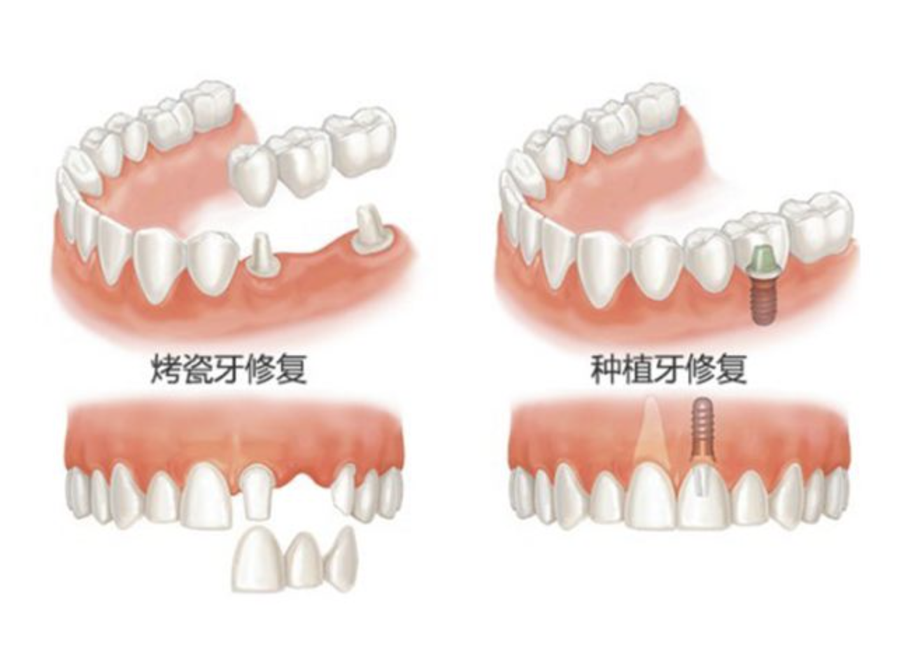 牙齒固定修複的方式