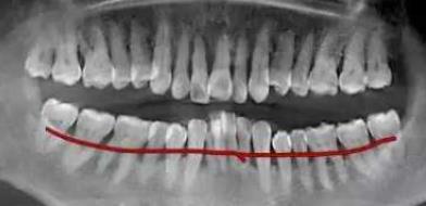 牙槽骨吸收的牙片